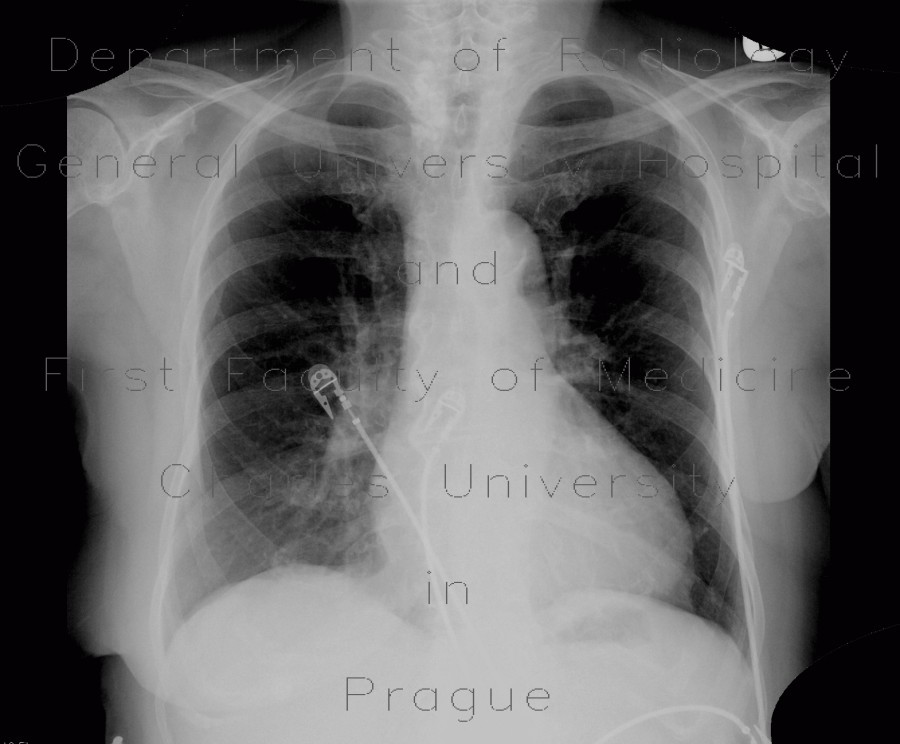 Calcifications in thyroid gland, goiter