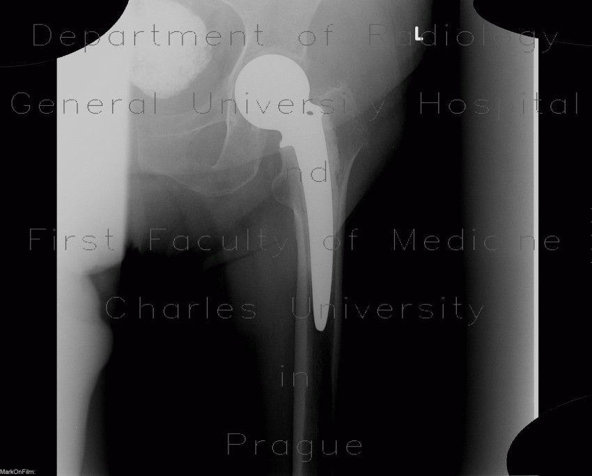 Calcifications in uterine fibroid, myoma, CEP, cervical endoprosthesis