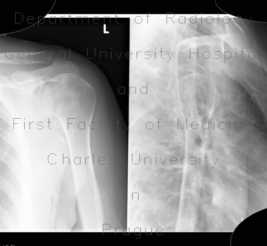 Radiology image - Calcified axillary lymph nodes: Thorax, Lymphatic: X-ray - Plain radiograph