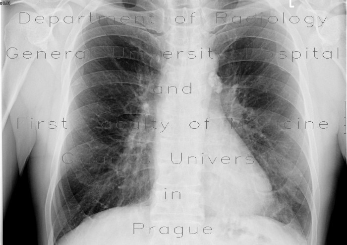 Radiology image - Calcified lymph node in lung hilum: Thorax, Lung: X-ray - Plain radiograph