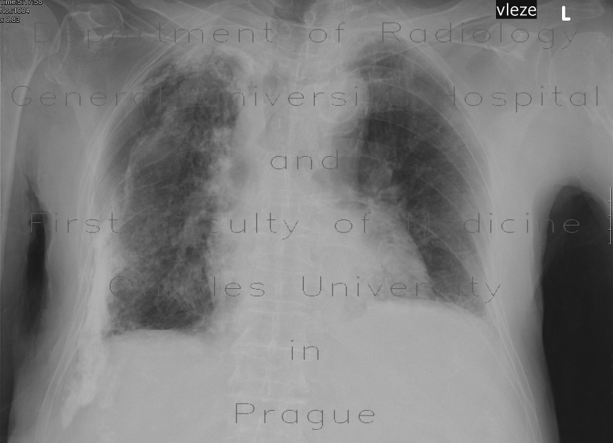 Calcified pachypleuritis, pachypleuritis calcarea