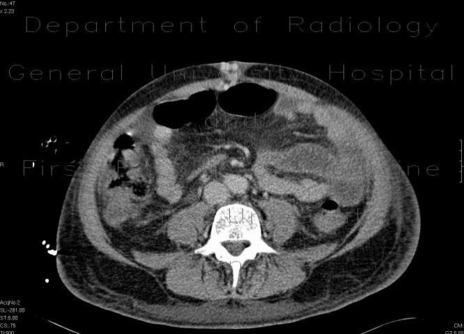 Radiology image - Caput medusae, porto-venous shunts, splenomegaly: Abdomen, Vessels: CT - Computed tomography