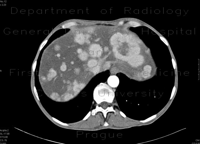 Carcinoid metastatses in the liver