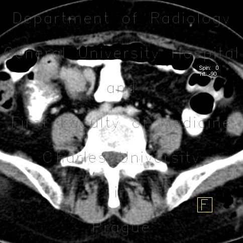 Carcinoid of ileum and mesentery, liver metastasis, CT enterography