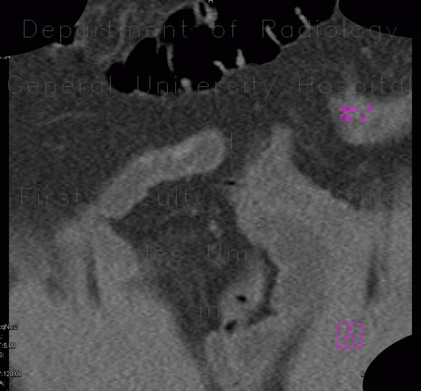 Radiology image - Carcinoid of small bowel: Abdomen, Small bowel: CT - Computed tomography