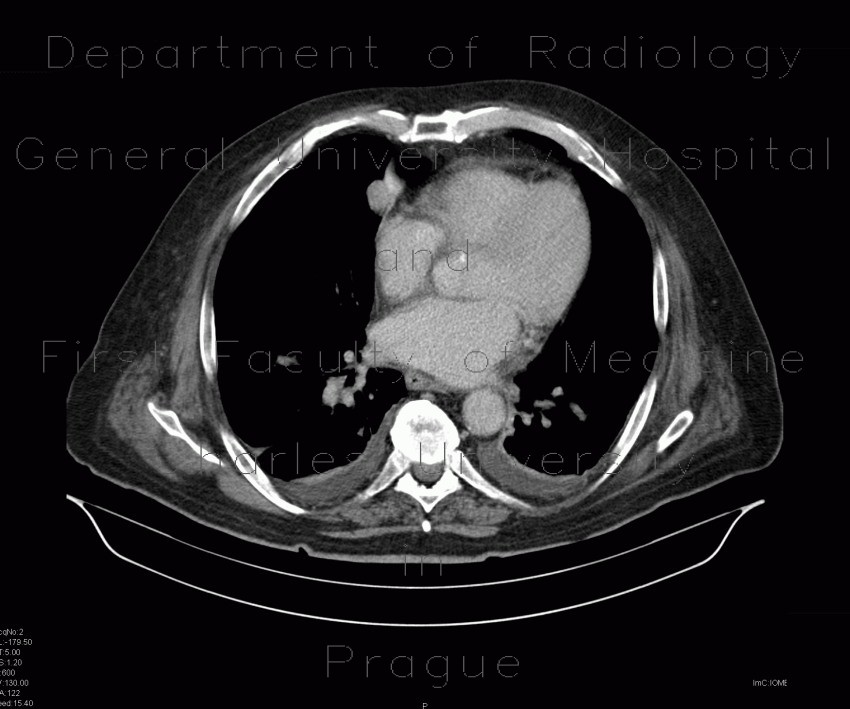 Radiology image - Carcinoid of the lung: Thorax, Lung: CT - Computed tomography