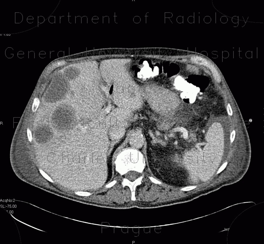 Radiology image - Carcinoma of bladder, metastasis in liver and abdominal wall, necrotic metastasis: Abdomen, Liver, Soft tissue, Urinary tract: CT - Computed tomography