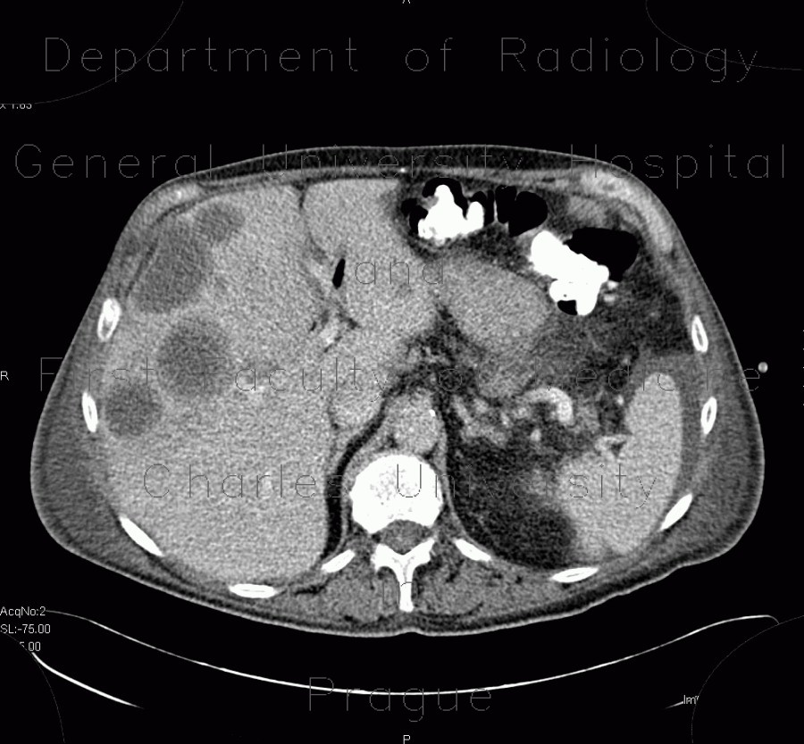 Carcinoma of bladder, metastasis in liver and abdominal wall, necrotic metastasis