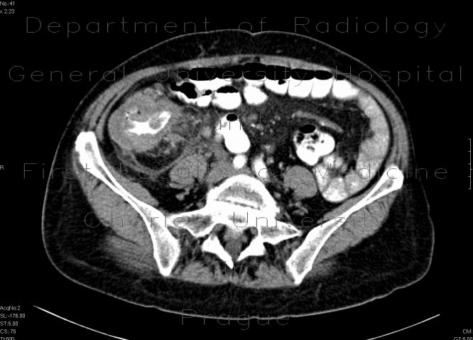 Radiology image - Carcinoma of cecum, necrotic lymph node: Abdomen, Large bowel: CT - Computed tomography