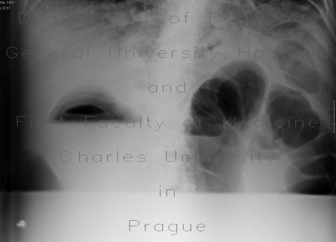 Radiology image - Carcinoma of colon, lienal flexure, large bowel ileus, lung metastasis: Abdomen, Thorax, Large bowel, Lung: X-ray - Plain radiograph
