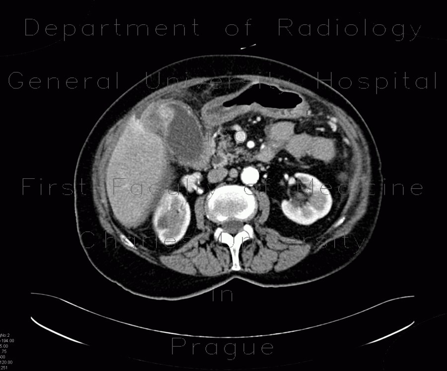 Carcinoma of gallbladder