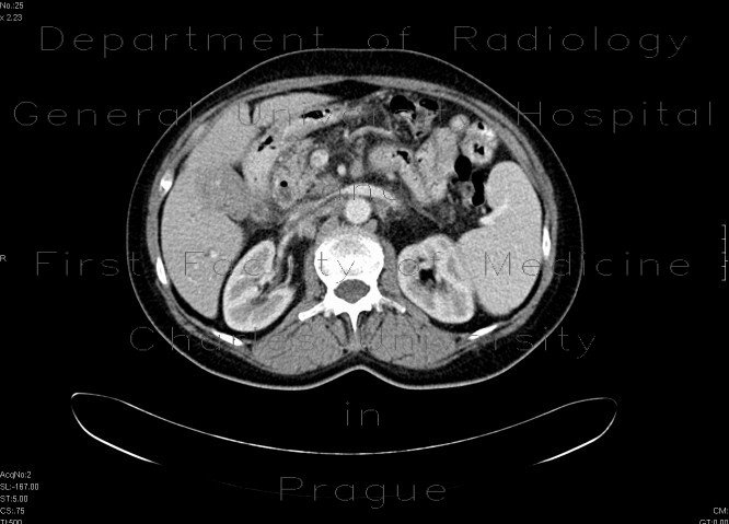 Radiology image - Carcinoma of gallblader: Abdomen, Biliary tree: CT - Computed tomography