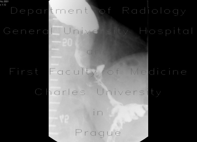 Radiology image - Carcinoma of oesophagus, stenosis: Thorax, Oesophagus: RF - Fluoroscopy