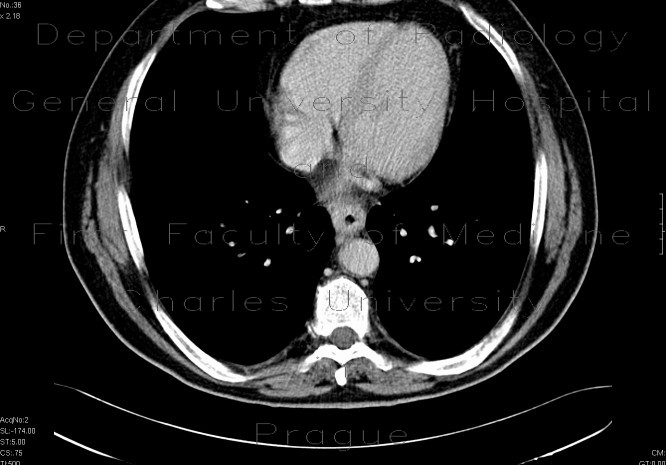 Radiology image - Carcinoma of oesophagus, tumorous stenosis: Thorax, Oesophagus: CT - Computed tomography