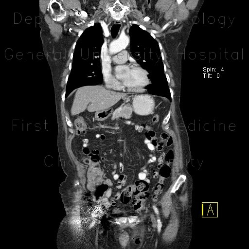 Radiology image - Carcinoma of pancreas: Abdomen, Pancreas: CT - Computed tomography