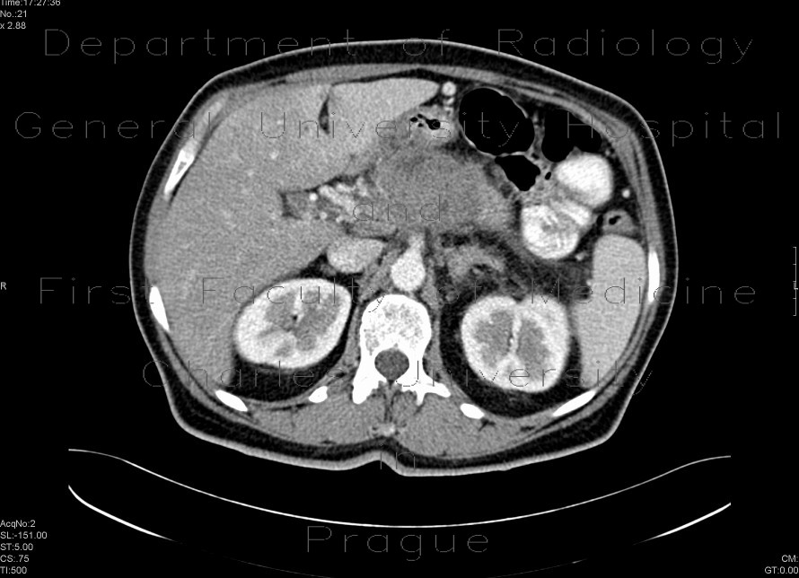 Carcinoma of pancreas