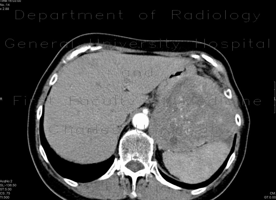 Radiology image - Carcinoma of pancreas, gigantic, liver metastases: Abdomen, Liver, Pancreas: CT - Computed tomography