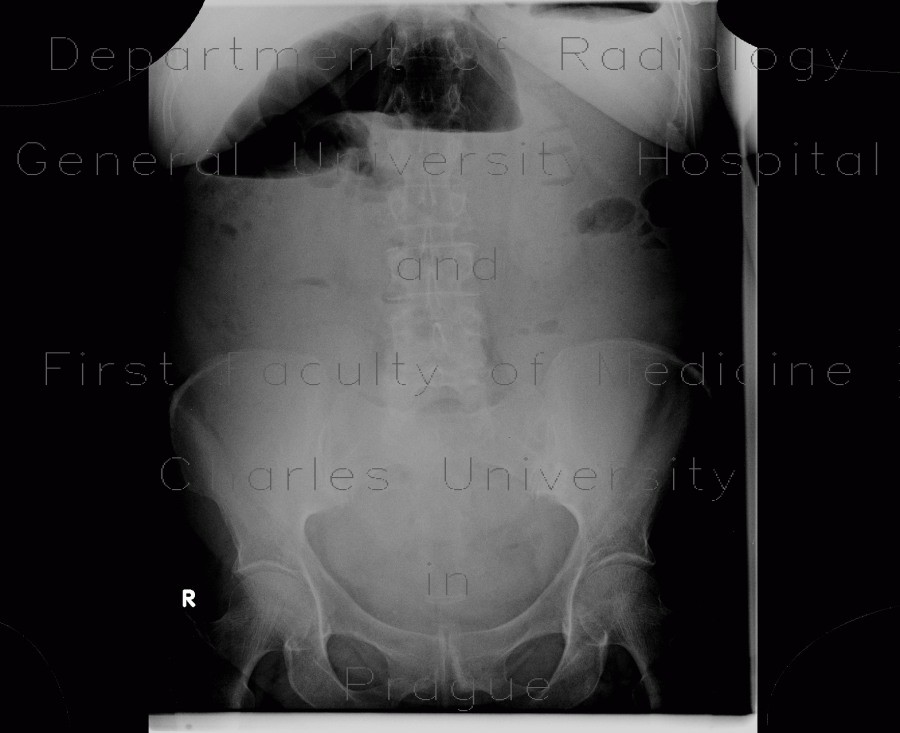 Radiology image - Carcinoma of sigmoid colon, large bowel obstruction, ileus: Abdomen, Large bowel: X-ray - Plain radiograph