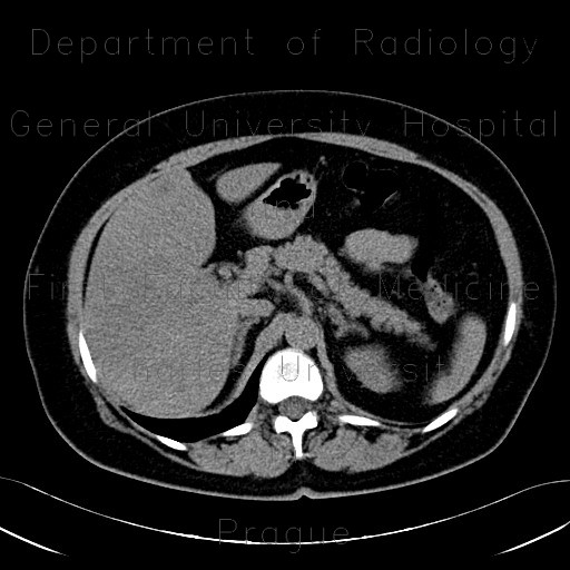 Radiology image - Carcinoma of sigmoid colon, metastasis of liver: Abdomen, Large bowel, Liver: CT - Computed tomography