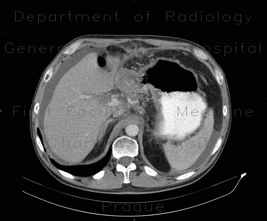 Radiology image - Carcinoma of stomach, scirrhotic carcinoma, infiltration of the wall: Abdomen, Stomach: CT - Computed tomography