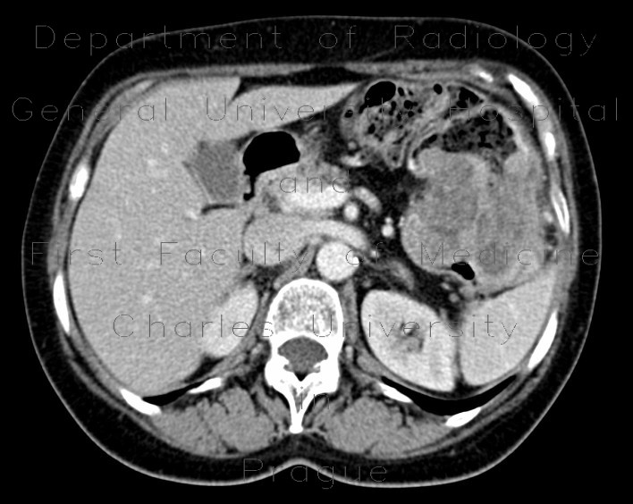 Radiology image - Carcinoma of the lienal flexure: Abdomen, Large bowel: CT - Computed tomography