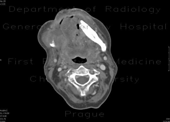 Radiology image - Carcinoma of the mouth floor and tongue: Head and Neck, Oral cavity: CT - Computed tomography