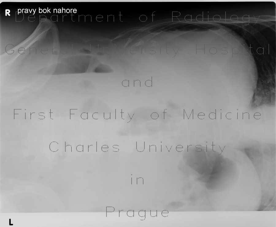 Carcinoma of transverse colon, ileus, perforation of bowel, peritonitis