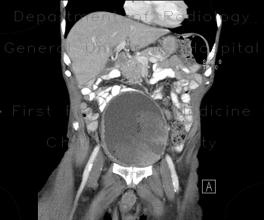 Carcinoma of urinary bladder, invasion into prostate