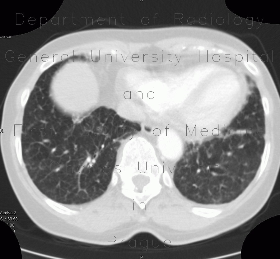 Radiology image - Carcinomatous lymphangoitis, lymphangoitis carcinosa, osteolysis of shoulder blade: Thorax, Bone, Lung: CT - Computed tomography