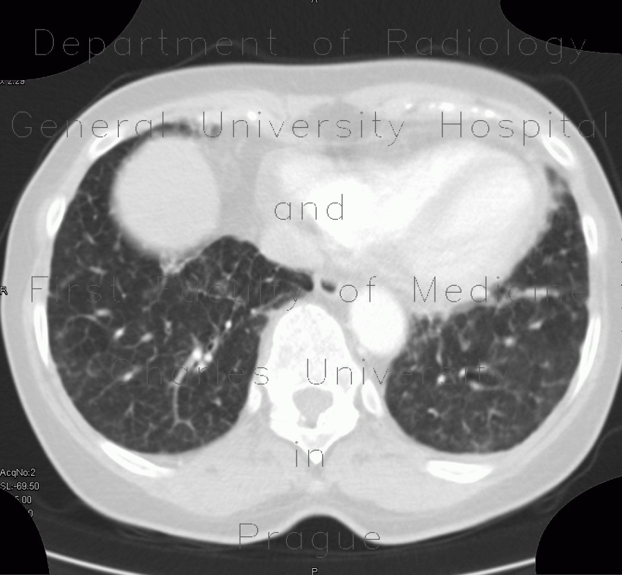 Carcinomatous lymphangoitis, lymphangoitis carcinosa, osteolysis of shoulder blade
