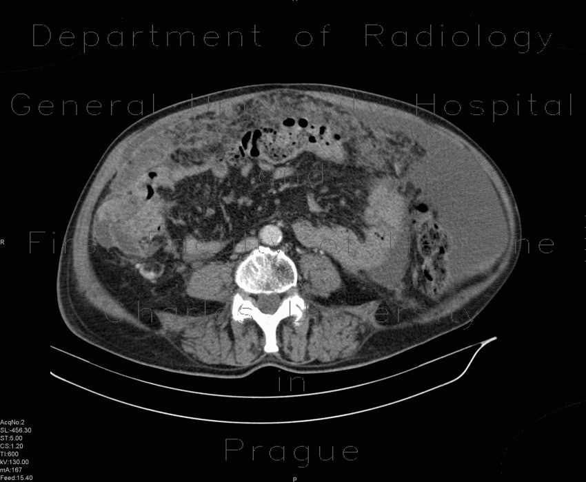 Radiology image - Carcinosis of the peritoneum: Abdomen, Peritoneal cavity: CT - Computed tomography