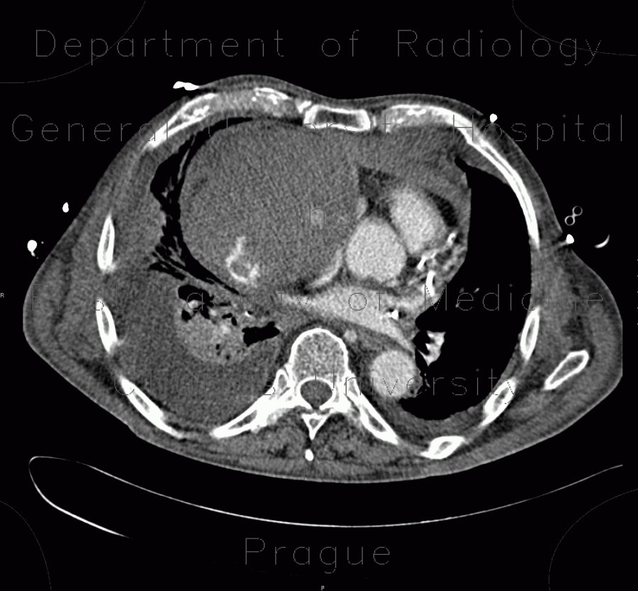 Cardiac tamponade, mediastinal hematoma, dissection of truncus brachiocephalicus