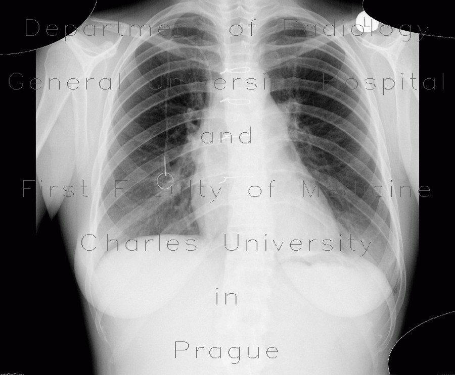 Cardiac tamponade, pericardial effusion