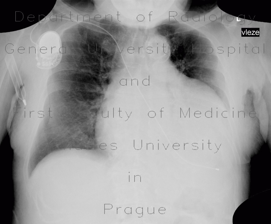 Cardiomegally on chest radiograph