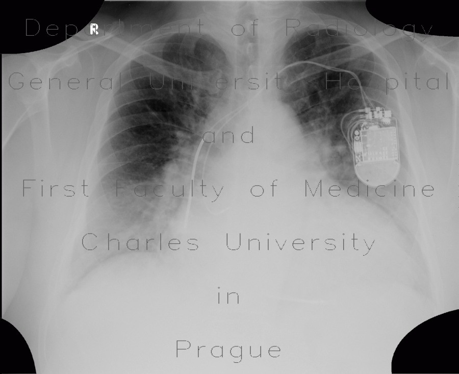 Cardiomyopathy, dilated cardiomyopathy