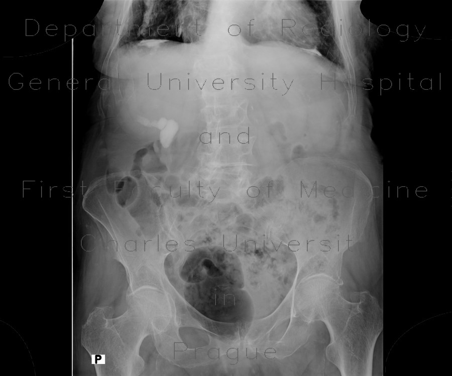 Casting renal stones, KUB radiograph