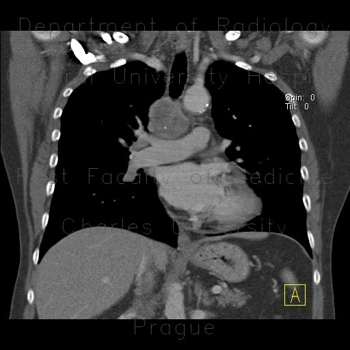 Castleman's disease