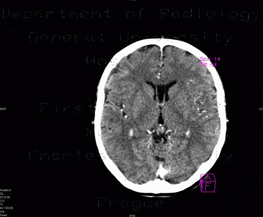 Radiology image - Cavum septi pellucidi: Brain, Brain: CT - Computed tomography