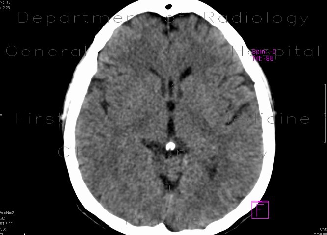 Radiology image - Cavum septi pellucidi: Brain, Brain: CT - Computed tomography