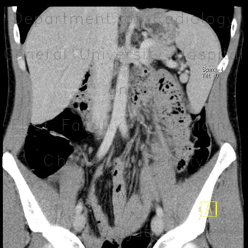 Radiology image - Celiac disease, foamy content of jejunum, CT enterography: Abdomen, Small bowel: CT - Computed tomography