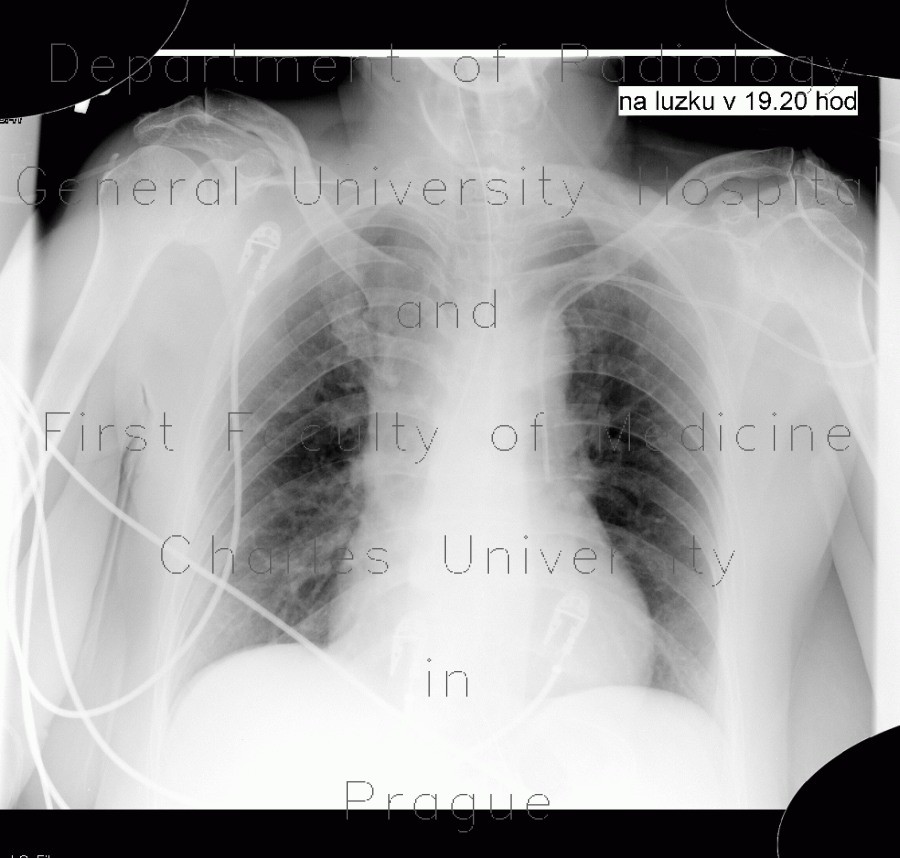 Central venous line, persistent left superior vena cava