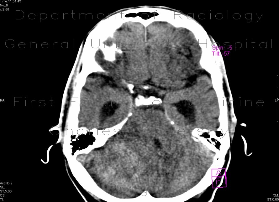 Radiology image - Cerebellar metastasis: Brain, Brain: CT - Computed tomography