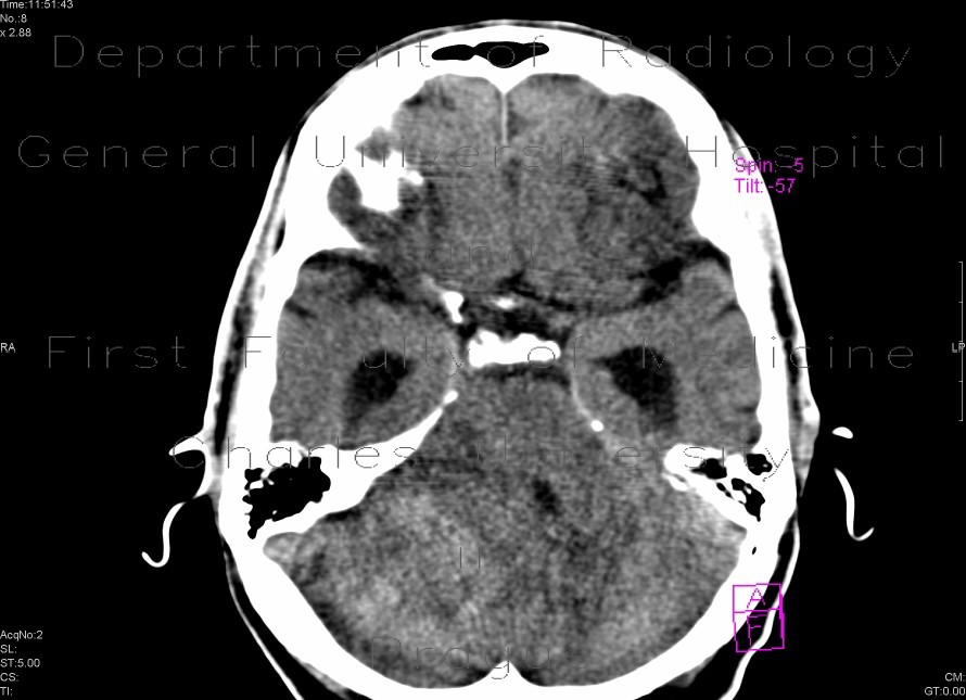 Cerebellar metastasis