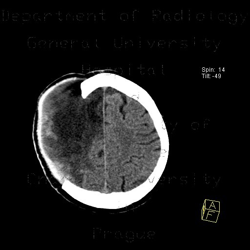 Radiology image - Cerebral ischemia, craniotomy, subarachnoid hemorrhage: Brain, Brain: CT - Computed tomography