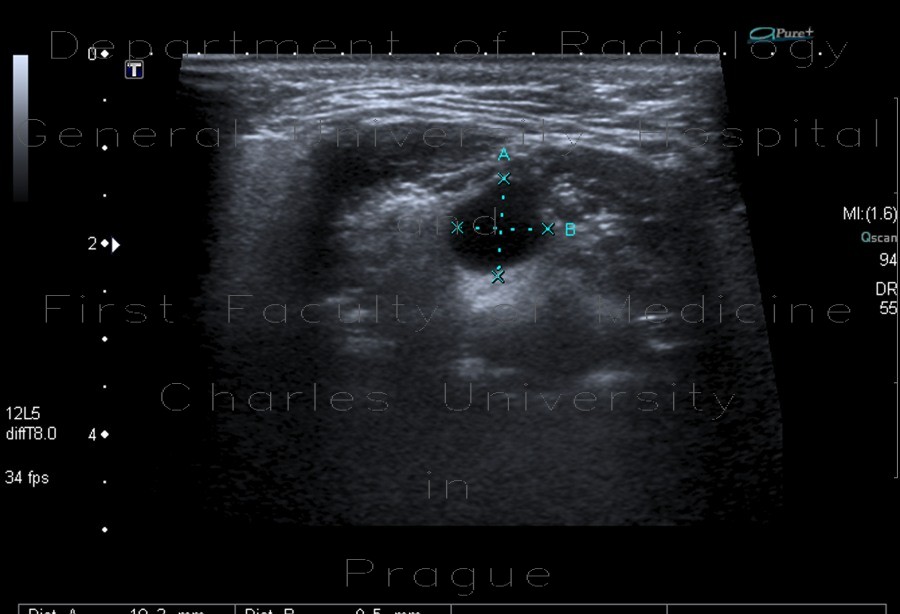 Cervical cyst, medial, retention cyst