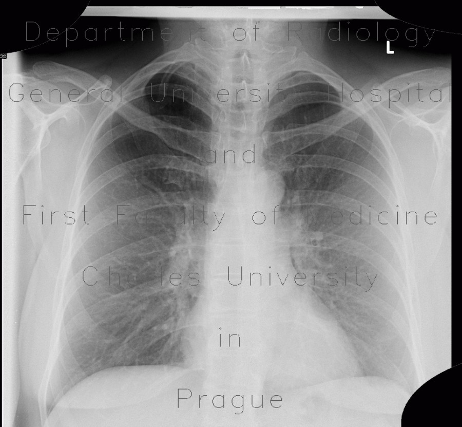 Radiology image - Cervical rib: Spine and Axial, Bone: X-ray - Plain radiograph