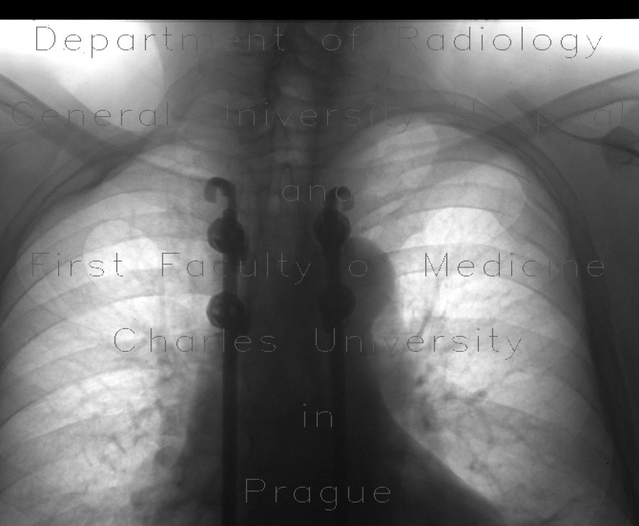 Cervical rib, megatransverse process, unilateral