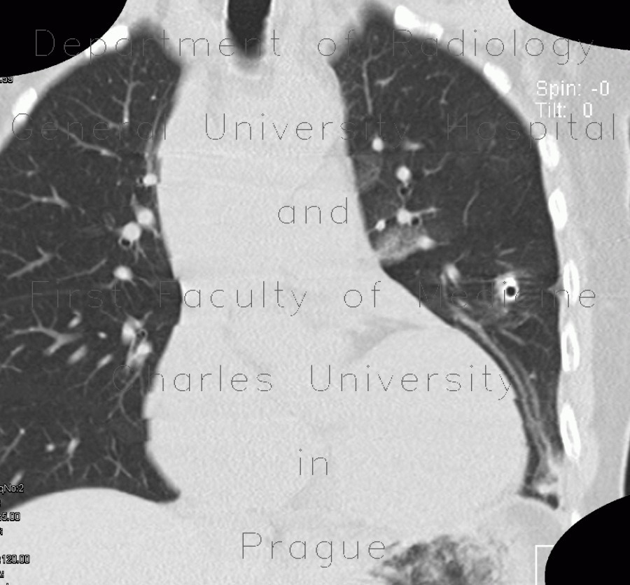 Radiology image - Chest tube, pleural drain: Thorax, Lung, Mediastinum and pleural cavity: CT - Computed tomography