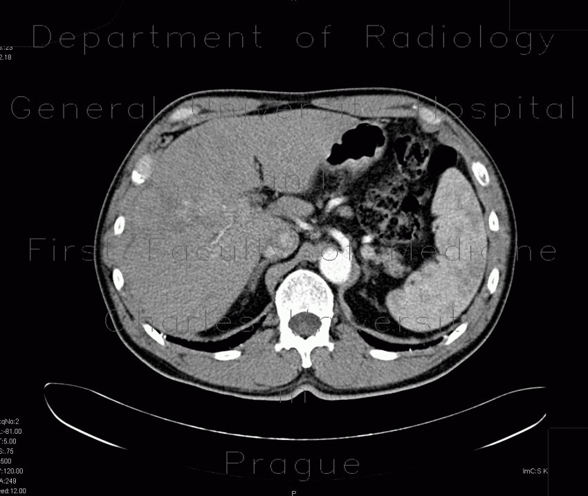 Radiology image - Cholangiocellular carcinoma: Abdomen, Liver: CT - Computed tomography
