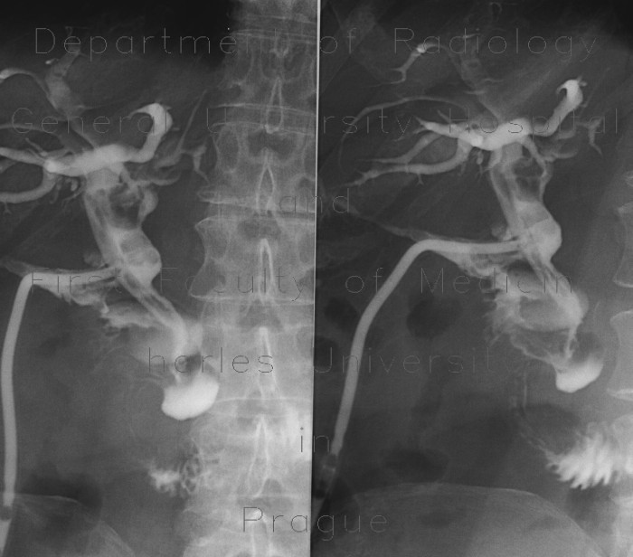 Cholangiography, T-drain, choledocholithiasis